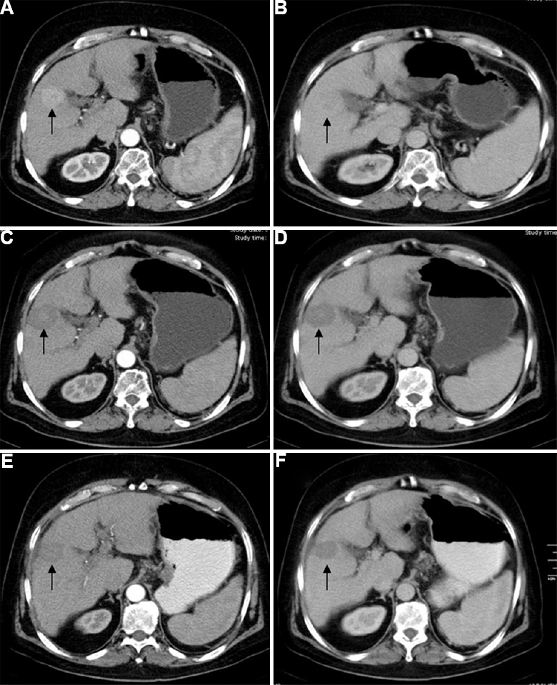 A 65 yr old male with hepatocellular carcinoma in segment 5 of liver treated with radiofrequency ablation alone. Pre-treatment arterial (A) and venous (B) phase images showing hypervascular lesion in segment 5 of liver (arrows). Post-radiofrequency ablation follow up imaging at three months (C & D) and six months (E & F) shows no residual enhancement in the lesion (arrows).
